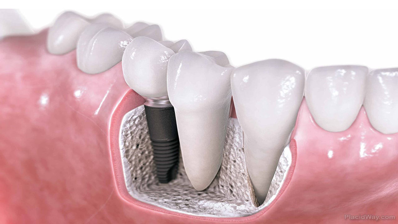 implant dentar