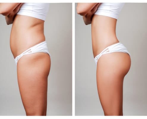 liposuctie-148